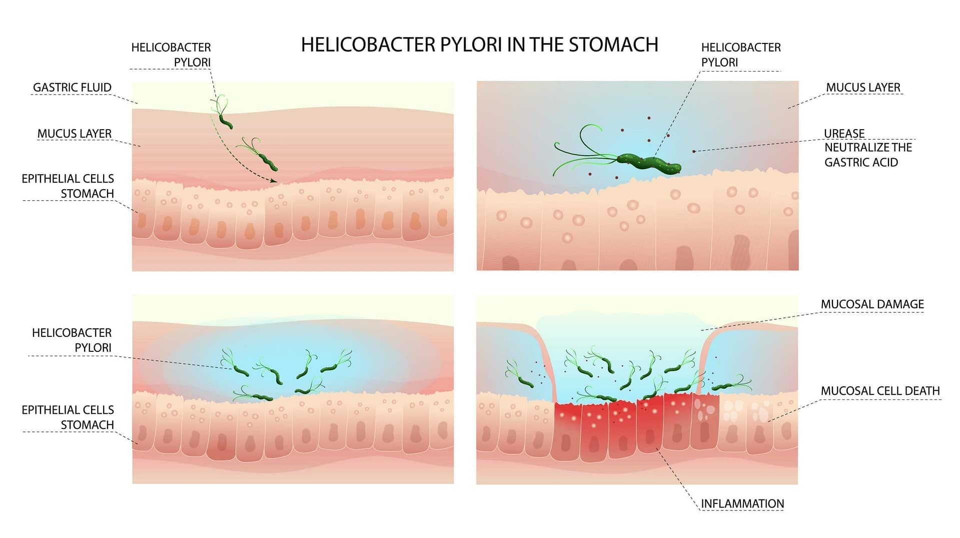 Helicobacter pylori