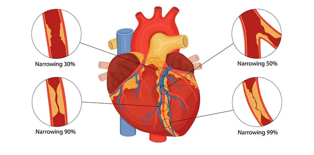 heart during ischemic heart disease