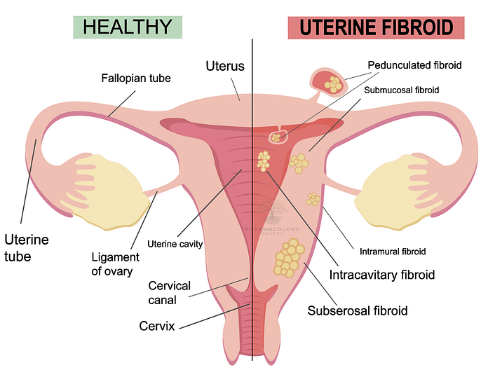 Linzagolix: uterine febroids