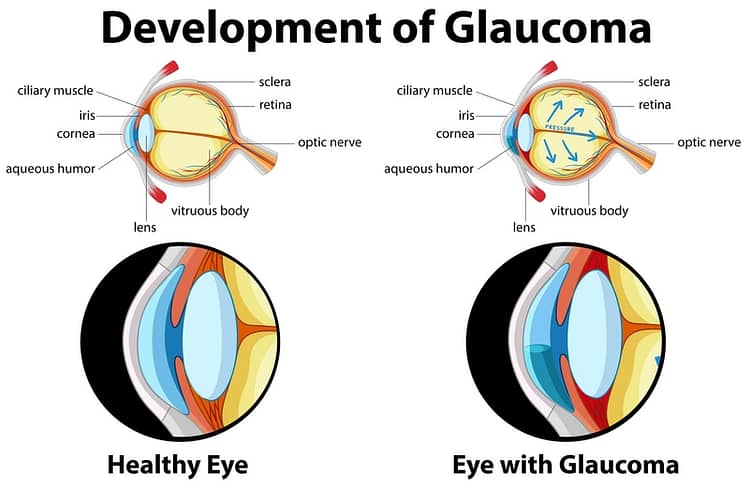 Diagram showing development of glaucoma